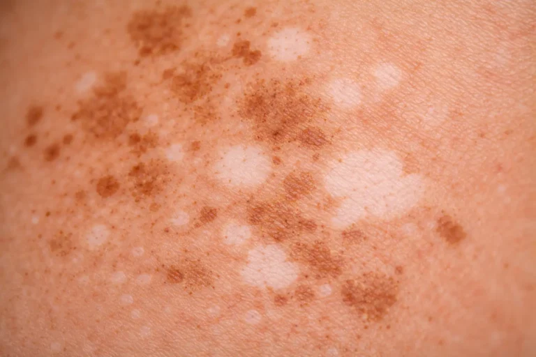 Sun Damage After Laser Hair Removal: A Clinical Guide to Identifying, Treating, and Reversing Skin Damage